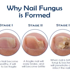 ATTDX NailRepair Fungus Treatment Pen