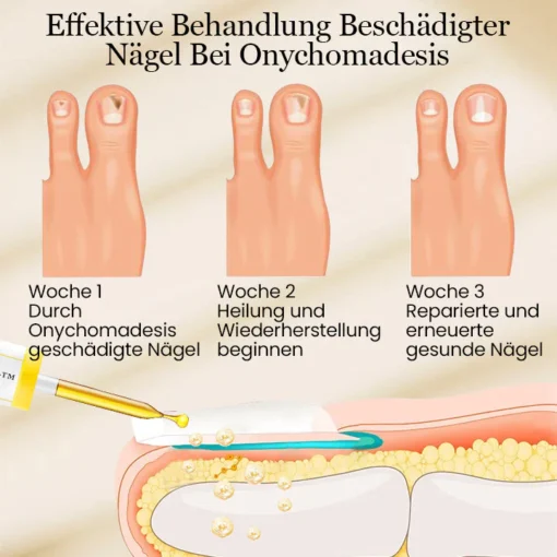 Biancat™ FungiMax Nagel Kräuter-Antipilz-Lösung