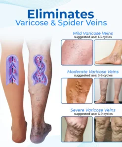 Biancat™ Legenda Varicose Vein Treatment Spray