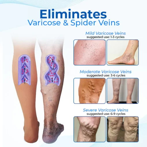 Biancat™ Legenda Varicose Vein Treatment Spray