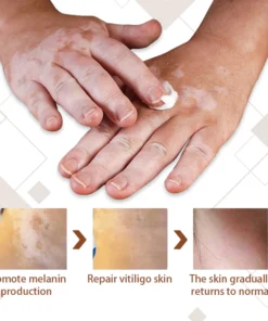 Ceoerty™ Advanced Squalene Vitiligo Treatment Cream