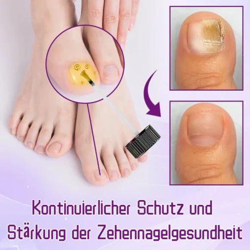 Ceoerty™ FungiShield Bienengift Zehennagelserum