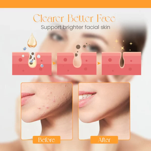 Ceoerty™ GlowBooty Acne Erasing Serum - Image 5