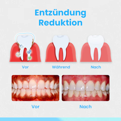 Ceoerty™ RevitaDent Zahnfleisch-Reparatur-Streifen