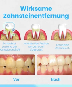 Ceoerty™ RevitaDent Zahnfleisch-Reparatur-Streifen