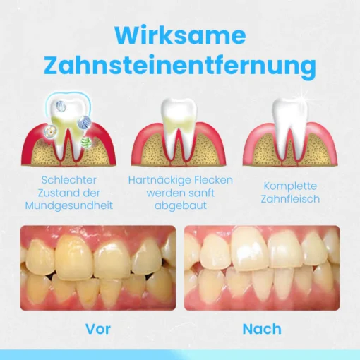 Ceoerty™ RevitaDent Zahnfleisch-Reparatur-Streifen