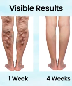 Ceoerty™ VeinMist Varicose Vein Spray