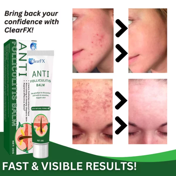 ClearFX™ Anti-Folliculitis Balm - Image 6