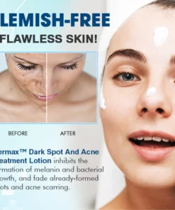 Dermax™ Dark Spot And Acne Treatment Lotion