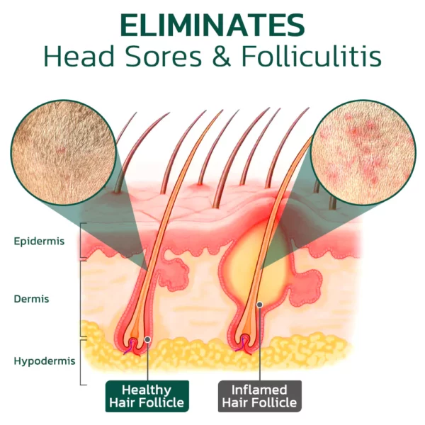 HairVive™ Scalp Folliculitis Therapy Oil - Image 3