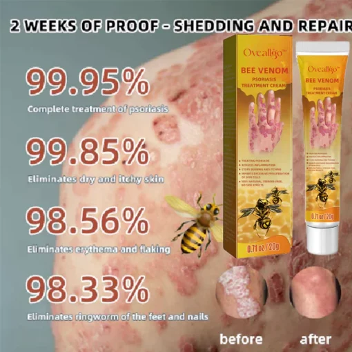 Oveallgo™ Bee Venom Psoriasis Treatment Cream - Image 3