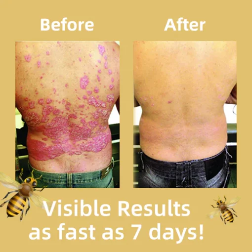 Oveallgo™ Bee Venom Psoriasis Treatment Cream - Image 6