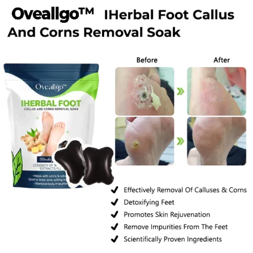 Oveallgo™ IHerbal Foot Callus And Corns Removal Soak - Image 4