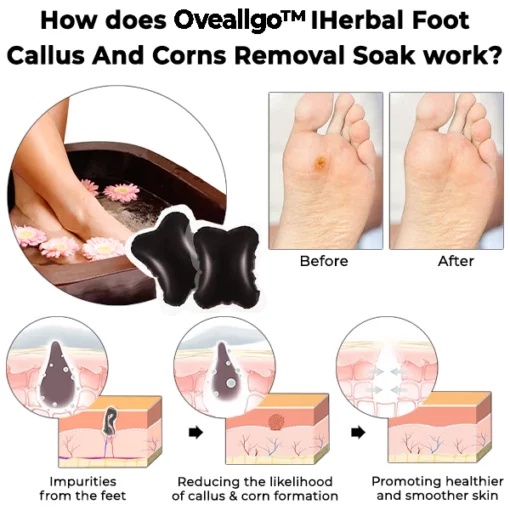 Oveallgo™ IHerbal Foot Callus And Corns Removal Soak - Image 2