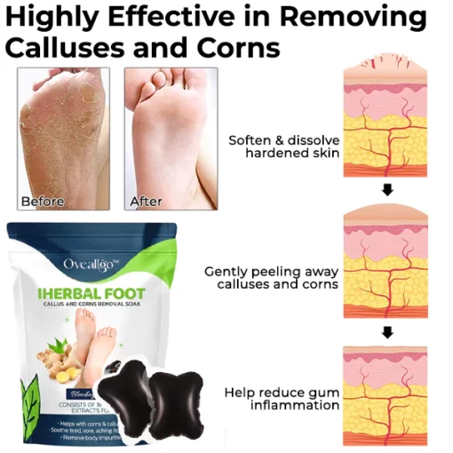 Oveallgo™ IHerbal Foot Callus And Corns Removal Soak - Image 3