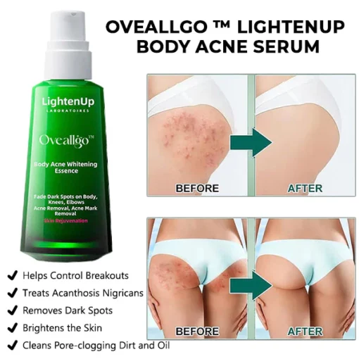 Oveallgo™ LightenUp Body Acne Serum - Image 4