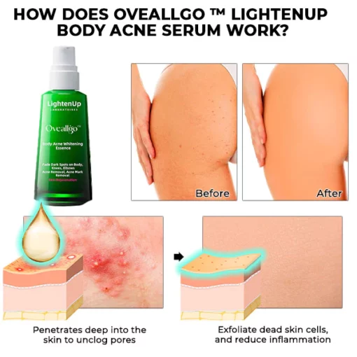 Oveallgo™ LightenUp Body Acne Serum - Image 2