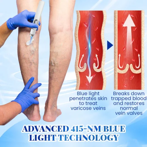 PosrystTM Blue Light Therapy Set for Varicose Veins