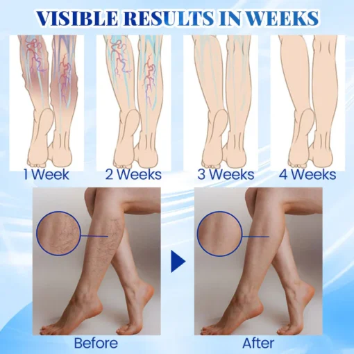 PosrystTM Blue Light Therapy Set for Varicose Veins