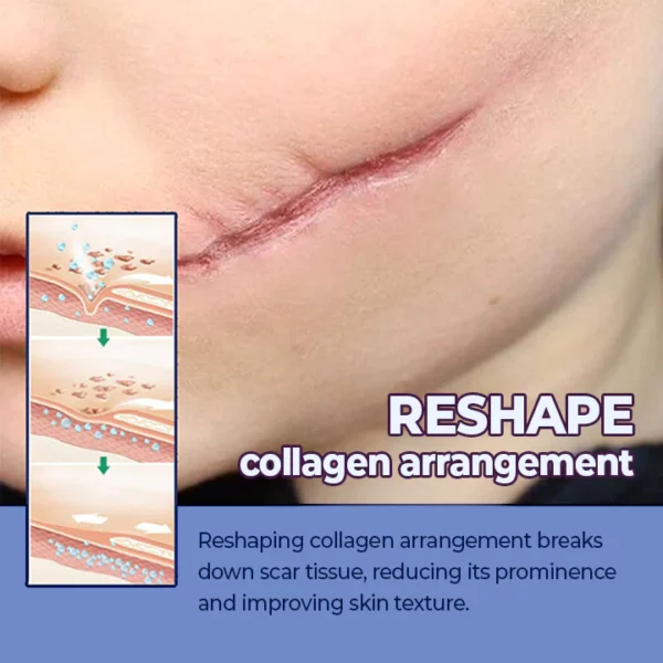 ScarFade™ UV Phototherapy Scar Removal Pen - Image 3