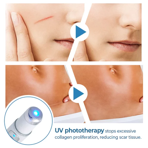 ScarFade™ UV Phototherapy Scar Removal Pen - Image 5