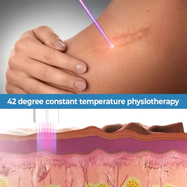 ScarFade™ UV Phototherapy Scar Removal Pen - Image 6