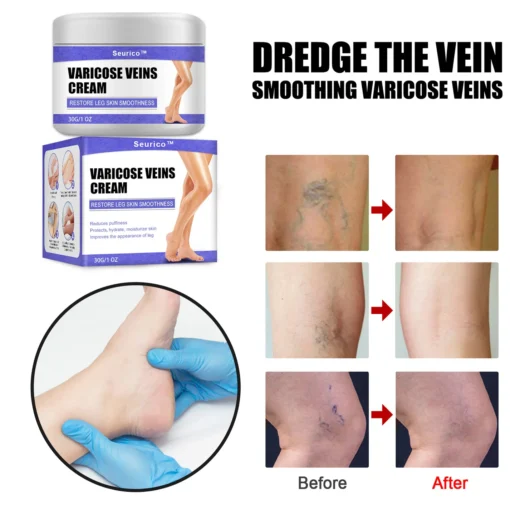 Seurico™ Varicose Veins Cream