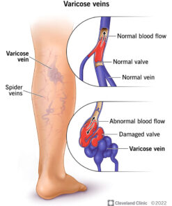 Seurico™ Varicose Veins Cream