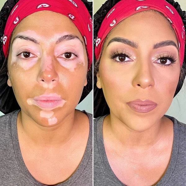 SkinDeux™ Bee Venom Vitiligo Cream