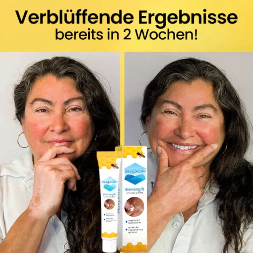 SkinDeux™ Bienengift Vitiligo Creme