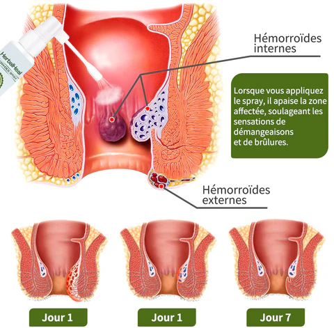 Spray d'herbes Hemocare™ pour les hémorroïdes- French