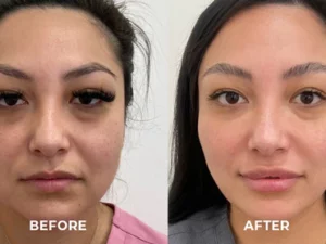 BeautyMAX™ V-Face Lifting Tape