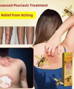 Bee Venom Psoriasis Treatment Cream