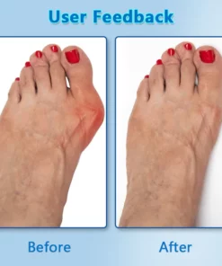 Biancat™ Bunions Correction Patch