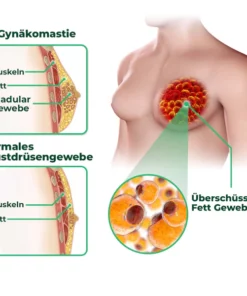 GFOUK™ GynoReduct Gynäkomastie-Reduzierungspflaster