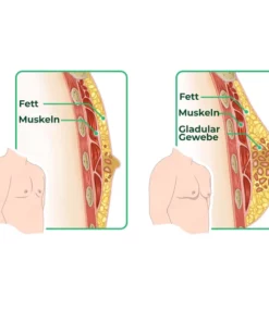 GFOUK™ GynoReduct Gynäkomastie-Reduzierungspflaster