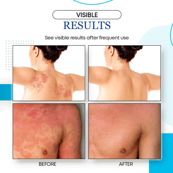 Relief Plus® Eczema Care Pads - Image 6