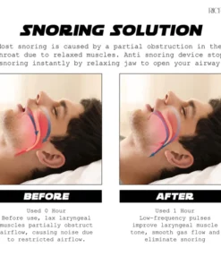 Ricpind AI Instant SnoringReduction Vibrating Stopper