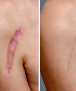 SkinFix™ Narbenreparatur-Essenz