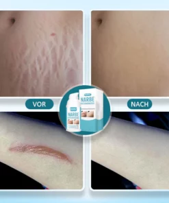 SkinPro™ Narbe Entfernungsgel