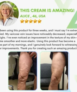 Varicose Vein Repair Cream