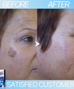 WART-LESS Immediate Blemish Removal Cream