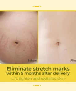 XRoland™ Olive Stretch Mark Treatment Oil