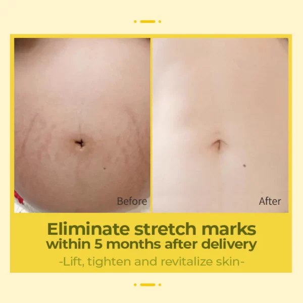 XRoland™ Olive Stretch Mark Treatment Oil