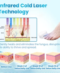 Ceoerty™ Antifungal Light Therapy Toenail Device