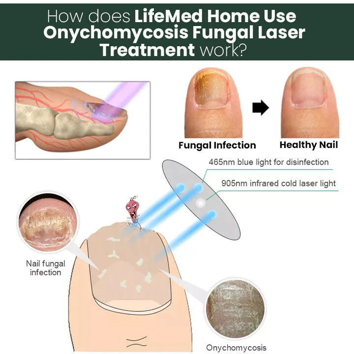 Oveallgo™ LifeMed Home Use Onychomycosis Fungal Laser Treatment