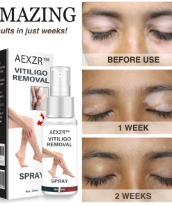 AEXZR™ Vitiligo Removal Spray