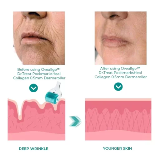 Oveallgo™ Dr.Treat PockmarksHeal Collagen 0.5mm Dermaroller - Image 4