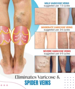 Raura™ Varicose Veins Treatment Spray