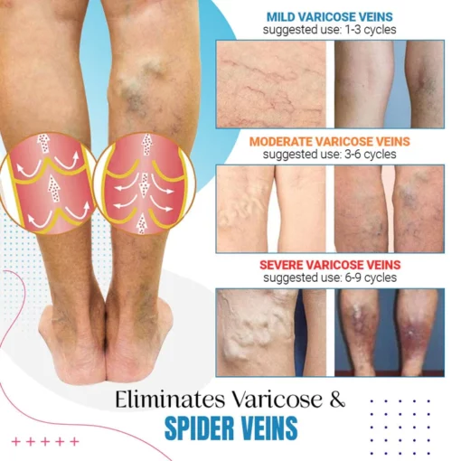 Raura™ Varicose Veins Treatment Spray